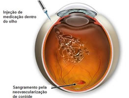 Retina