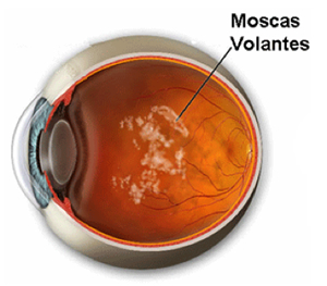 Retina