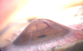Ceratocone