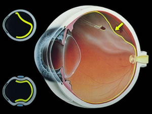 Sintomas Retina