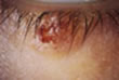 Tumor