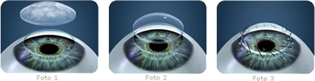 Cornea
